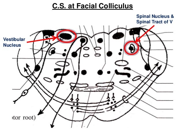 Facial colliculus syndrome picture 123